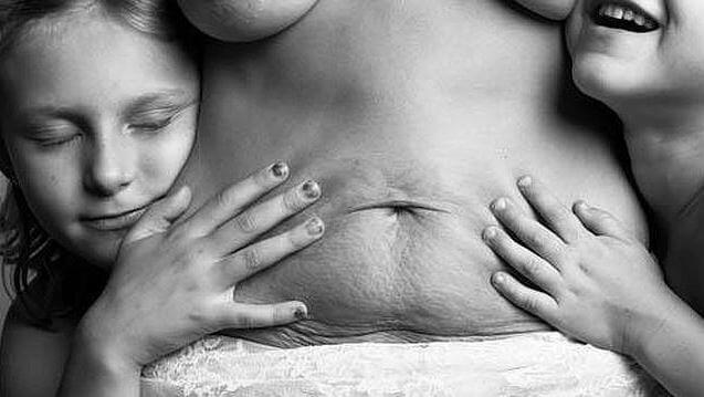 Ci sono cicatrici che ci ricordano la cosa più bella della vita: i figli