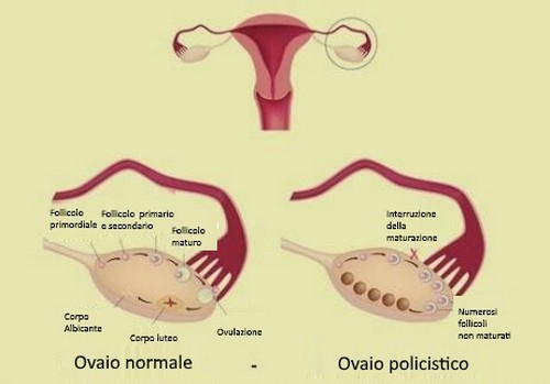 Convivere con la sindrome dell'ovaio policistico