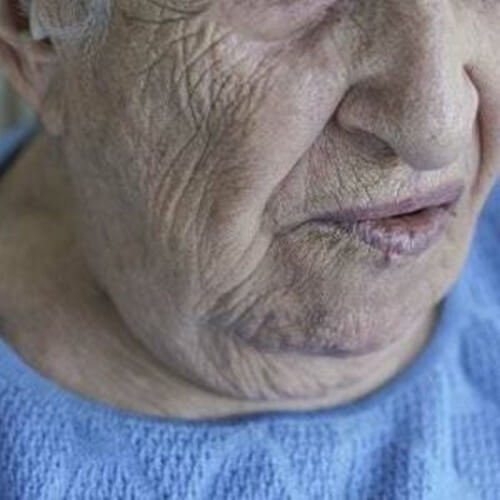 Paralisi facciale e conseguenze sociali