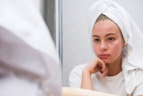 Effetti psicologici dell'acne giovanile