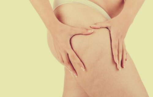 Lipedema, oltre l'obesità: sintomi e trattamento